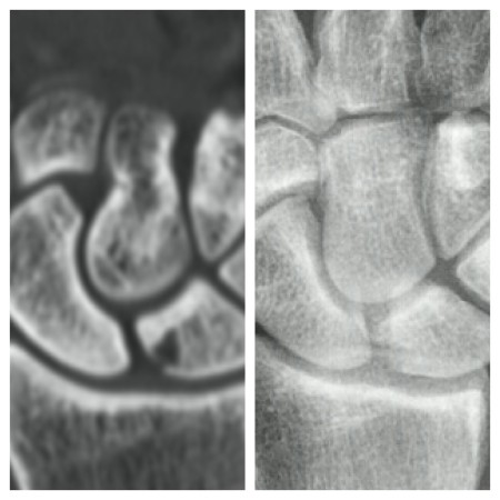 Spot the difference: Before (CT) and after surgery (X-ray)